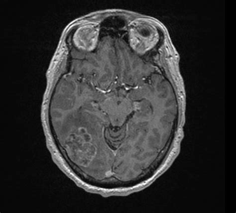 Brain Tumor Cancer Mr Imaging Of The Brain Radtechonduty