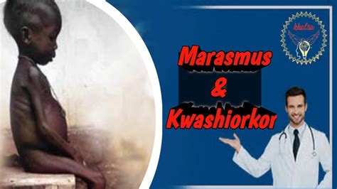 13 Pem Marasmus And Kwashiorkor Pediatric Youtube