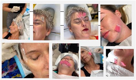 Thread Lifts Newcastle Facial Rejuvenation The Icon Cosmetic Clinic