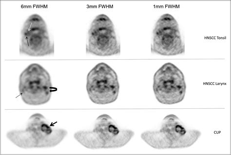 Effect Of Reconstruction Parameters In High Definition Petct On