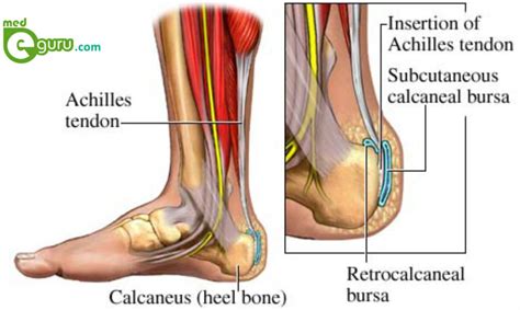 Bone spurs (extra bone growth) often form with this type. what is Achilles Tendinitis | Achilles Tendon InjuryMed E Guru