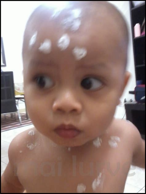 It is highly contagious (spreads easily) to people who haven't had the disease or have not been vaccinated against it. blog kay & yana: Throwback : Aryan Chicken Pox / Cikenpox