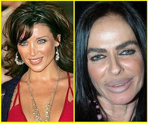 10 Celebrity Plastic Surgery Disasters Before And After Celebrity