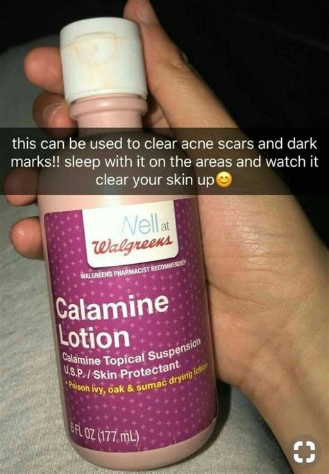 Calamine Lotion For Acne Sam Grant