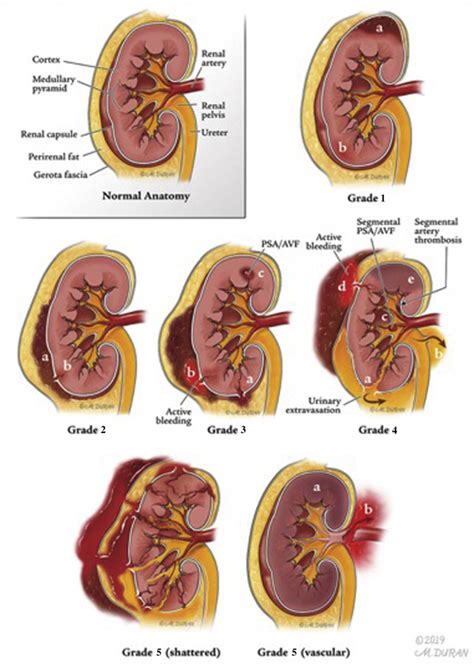 Review Of Multimodality Imaging Of Renal Trauma Radiology Key