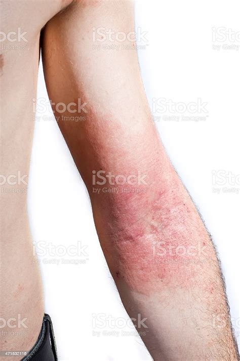 Skin Dermatitis Rash On Inside Of Males Elbow Stock Photo Download