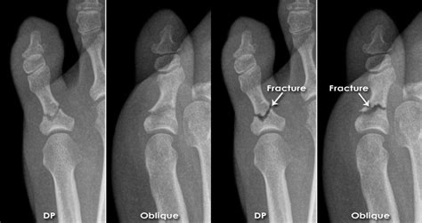 Trauma X Ray Lower Limb Gallery 2 Foot Other Injuries