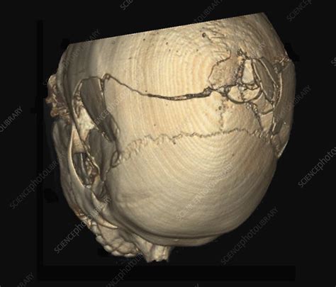 Skull Fractures 3d Ct Scan Stock Image C0389357 Science Photo
