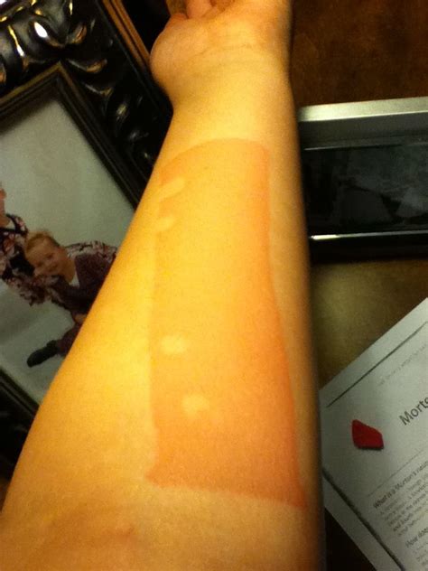 This Is My Arm When U Burnt Itit Hurt Really Bad It Hurts Burns