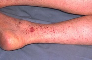 Rocky Mountain Spotted Fever « Disease Images « CFSPH