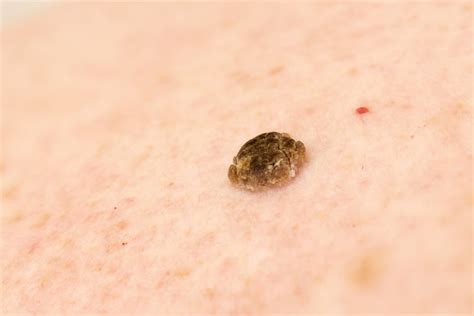 Keratosis Growths On The Skin That Can Be Dangerous Alterswarzen