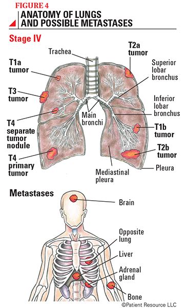 Types Of Lung Cancer Tumors