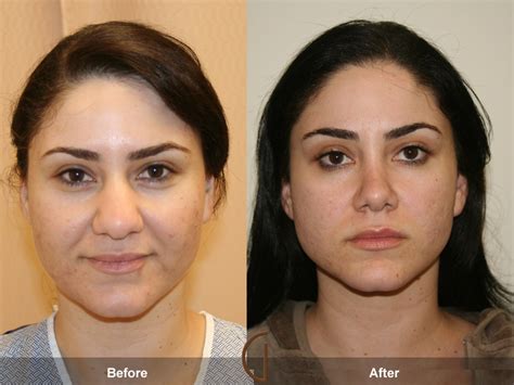 Aesthetic Plastic Surgery Center Thomasville Ga Newspaper Failed Cosmetic Surgery Lip Piercing