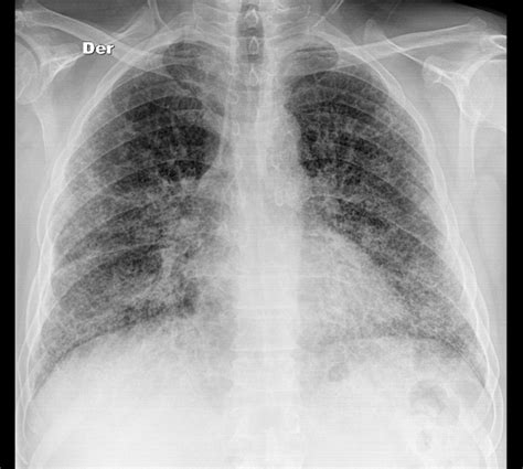 Interstitial Pneumonia X Ray