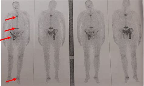 Whole‐body Bone Scintigraphy Showing High Osteoblastic Activity In The