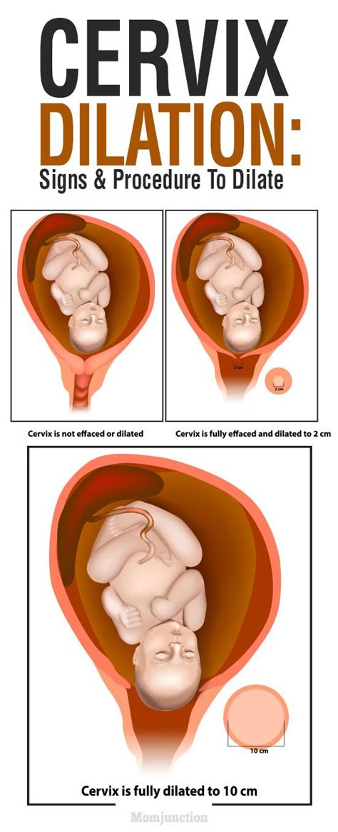 Cervix Dilation Signs And Procedure To Dilate Cervix Dilation Cervix Mom Junction