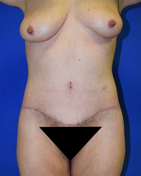 Extended Tummy Tuck Before And After