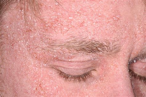 Seborrheic Dermatitis Red Patches On Face Treatment S