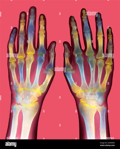 Arthritic Hands Coloured X Ray Of A Pair Of Hands Showing Rheumatoid