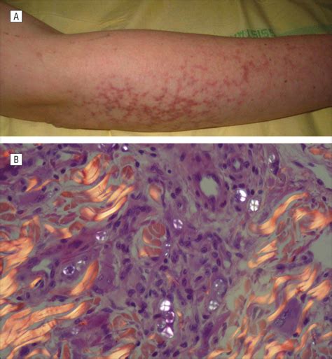 Livedoid And Necrotic Skin Lesions Due To Intra Arterial Buprenorphine