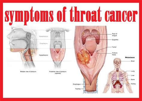 Throat Cancer Info Symptoms Of Throat Cancer