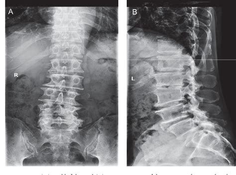 Figure 1 From Lumbar Scoliosis Combined Lumbar Spinal Stenosis And