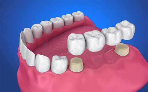Dental Bridges A Great Option For Replacing Missing Teeth Saby Dental