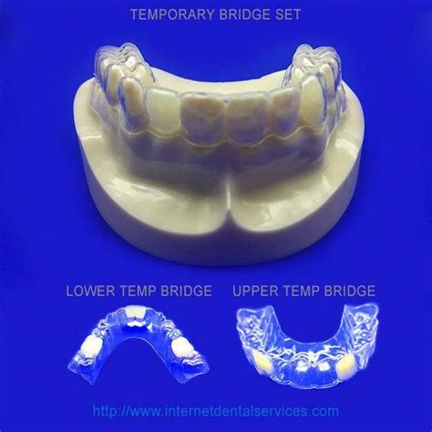 Can dental bridges always replace missing teeth? Pin on Dental Bridge Other