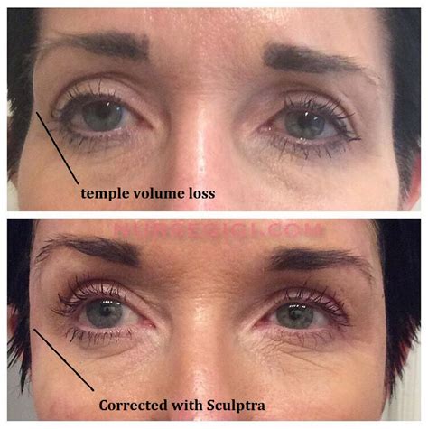 Lifting The Face By Filling The Temples With Sculptra — Nurse Gigi