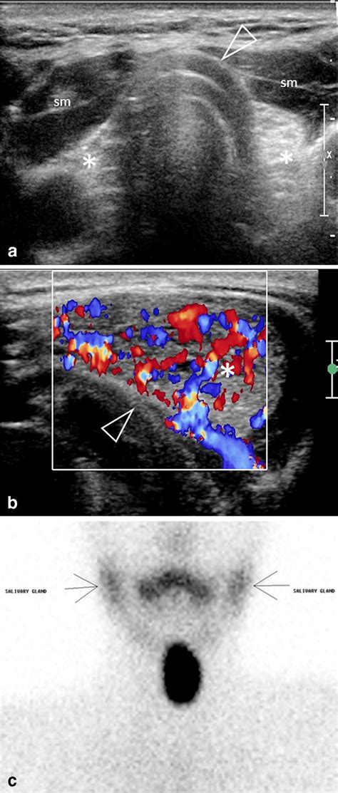 Ectopic Thyroid In A 17 Year Old Girl With Late Onset Of Hypothyroidism