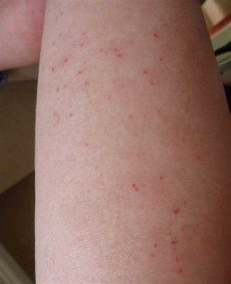 I Have Eczema Day 97 Of Topical Steroid Withdrawal