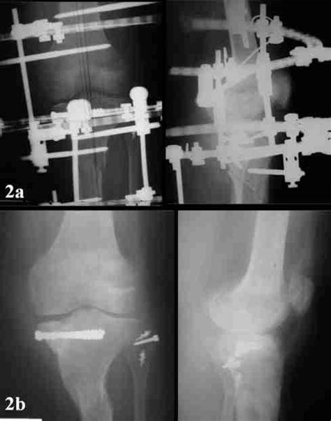 A Deformity Correction With High Tibial Osteotomy And Application Of