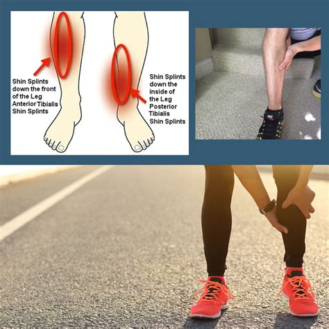 What Are The Symptoms Of Shin Splints Hot Sex Picture