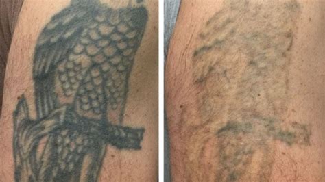 Tattoo Removal Sources Of Your Unwanted Tattoo Teggioly