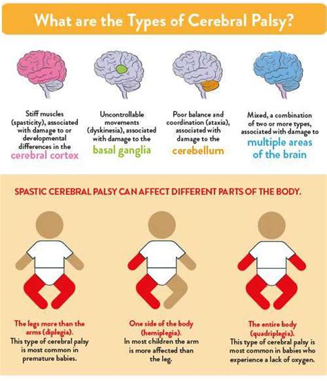 Cerebral palsy is a general term for a group of disorders impacting a person's motion, balance, and posture. Infographic: Understanding Cerebral Palsy | Gillette ...