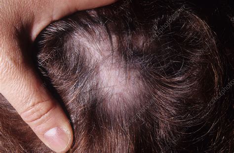 Hair Loss From Lupus Stock Image C0465397 Science Photo Library