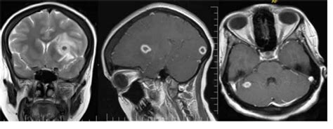Figure From Magnetic Resonance Imaging Findings Of Intracranial