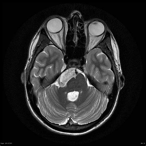 Epidermoid Cyst Cerebellopontine Angle Image