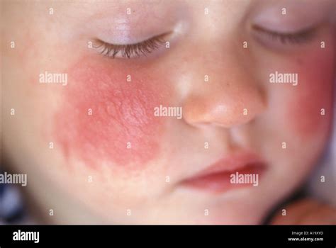 Cheeks Of Child With Eczema Stock Photo Alamy
