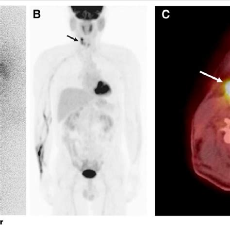 A 72 Y Old Woman With Papillary Thyroid Cancer Underwent 131 I Ablation