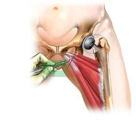 There are five flexor tendon zones in hand. Adductor Muscles of the Hip | ... of the adductor muscle tendons following a total left hip ...