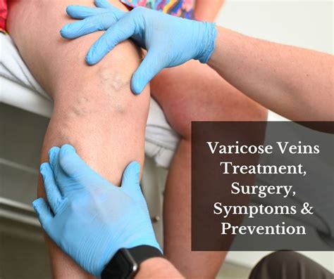 Varicose Veins Treatment Surgery Symptoms And Prevention