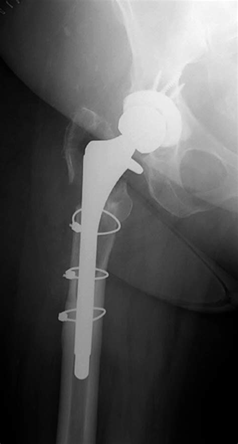 Revision Total Hip Arthroplasty Via Extended Trochanteric Osteotomy
