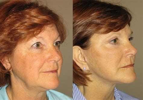 Facelift Photo Patient Guyette Facial Oral Surgery Center