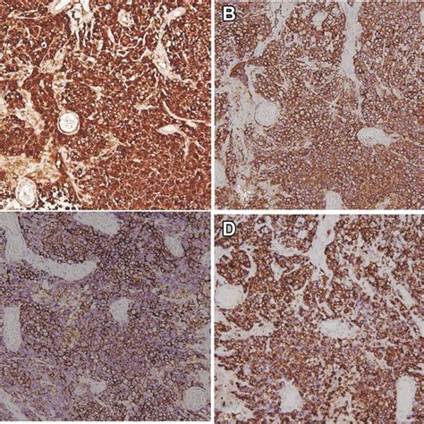 Mucinous Borderline Tumor And Large Cell Neuroendocrine Carcinoma The