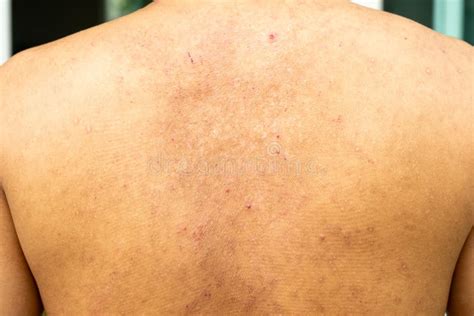 Closeup Image Of A Male Body Suffering From Chronic Skin Rash Food