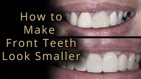 How To Make Big Teeth Smaller At Home Teethwalls