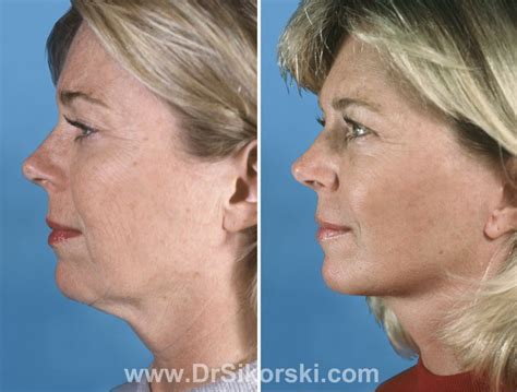 Orange County Facelift Before And After Photos Dr Sikorski Natural