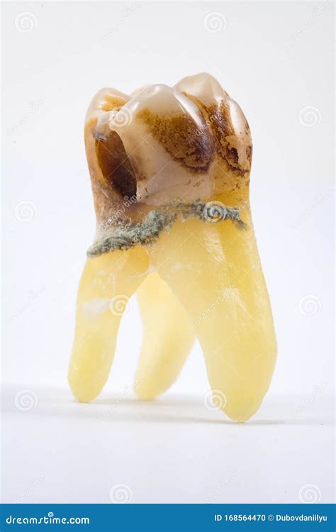 Extracted Caries Tooth Isolated Stock Photo Image Of Hole Mouth