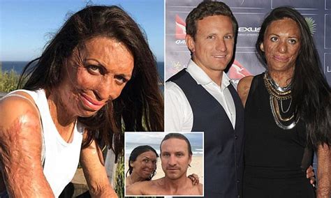 Turia Pitt on her supportive fiancé Michael Daily Mail Online